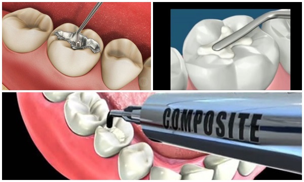 Sau khi trám răng cần lưu ý điều gì Sau khi trám răng cần lưu ý điều gì